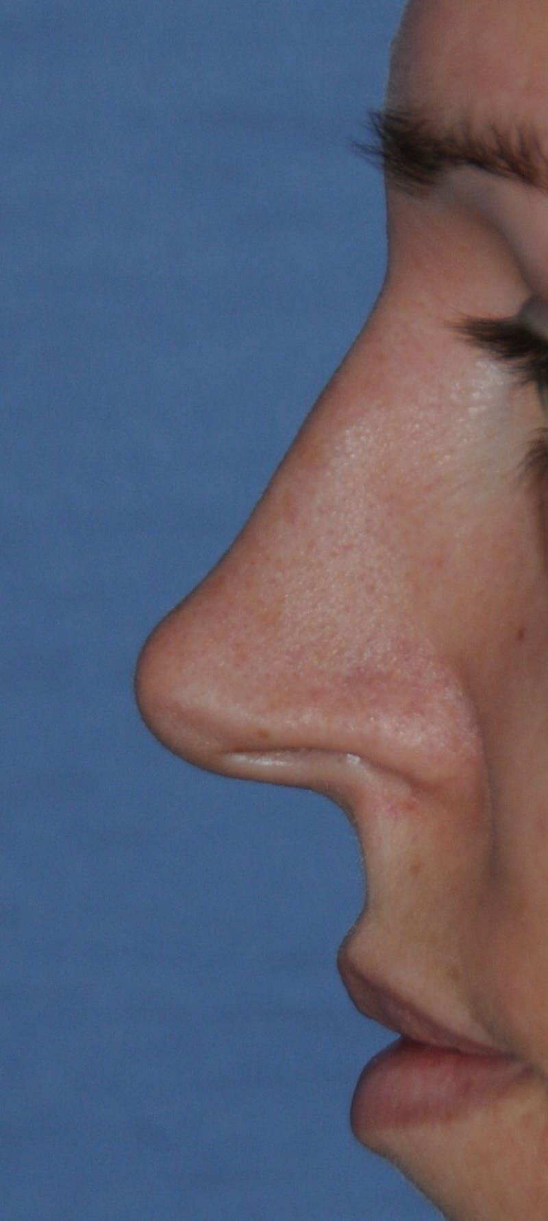 Rhinoplasty Before & After Gallery - Patient 452526 - Image 3
