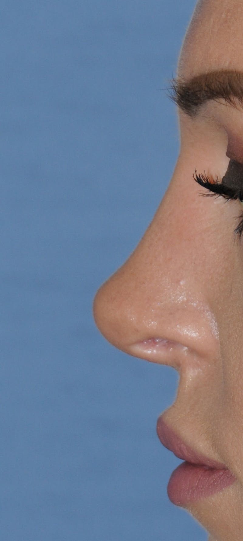 Rhinoplasty Before & After Gallery - Patient 452526 - Image 4