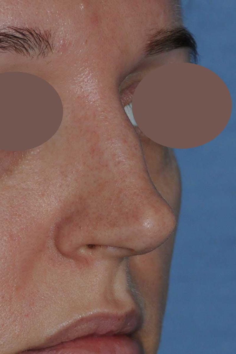 Rhinoplasty Before & After Gallery - Patient 452526 - Image 5