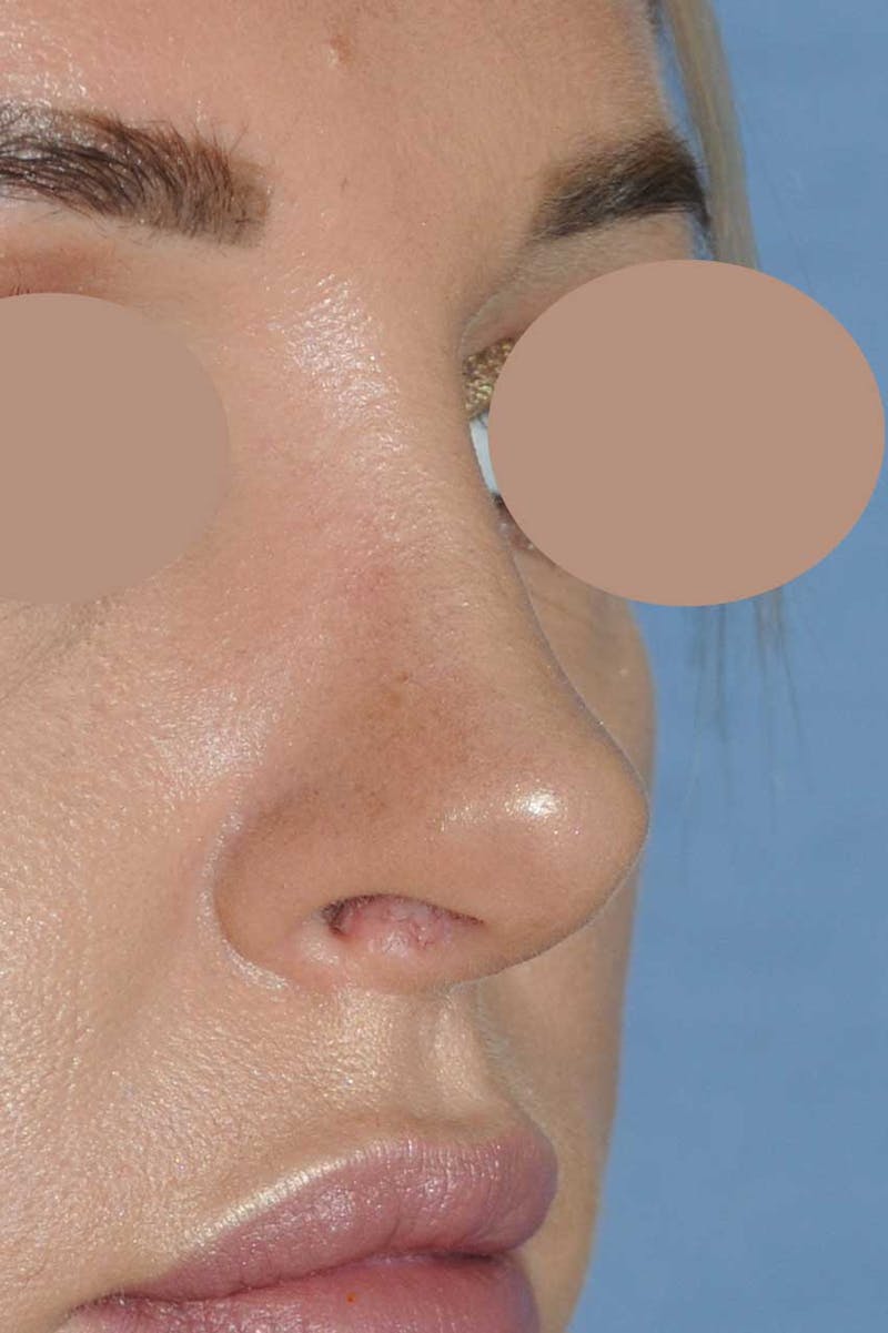 Rhinoplasty Before & After Gallery - Patient 452526 - Image 6