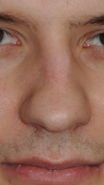 Rhinoplasty Before & After Gallery - Patient 179258 - Image 1