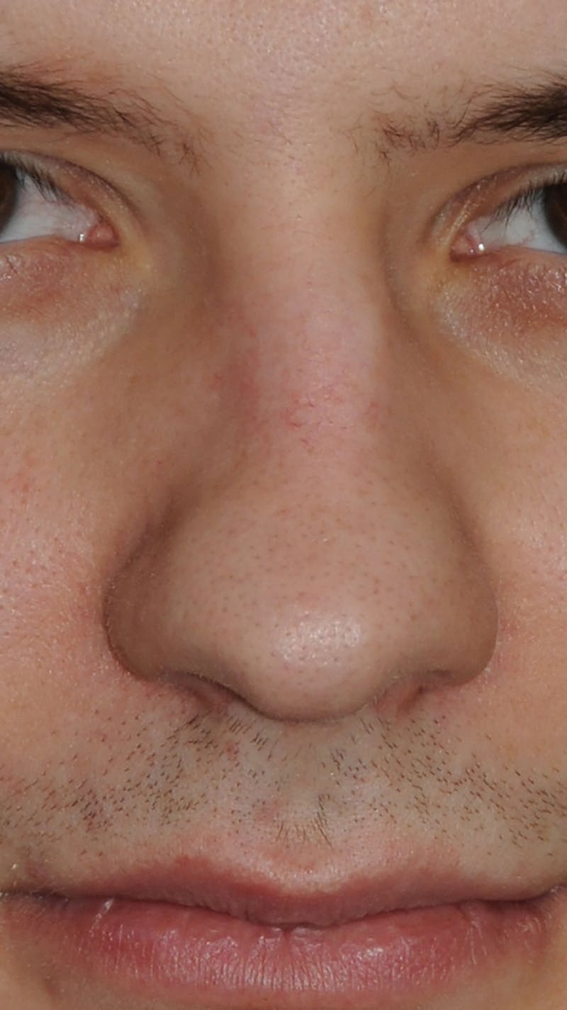 Rhinoplasty Before & After Gallery - Patient 179258 - Image 1