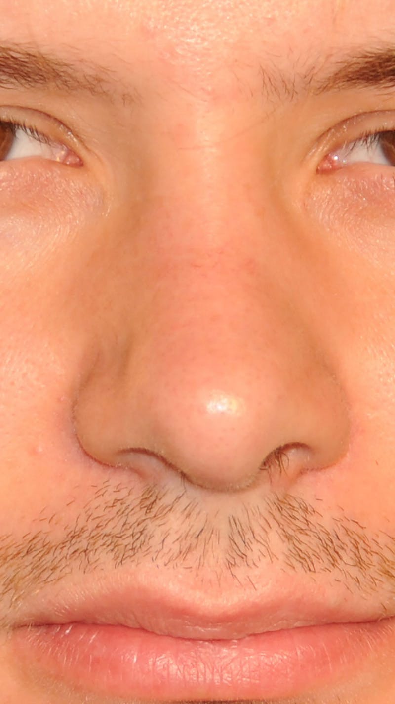 Rhinoplasty Before & After Gallery - Patient 179258 - Image 2