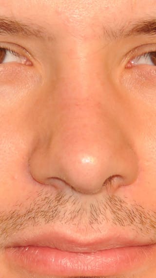 Rhinoplasty Before & After Gallery - Patient 179258 - Image 2