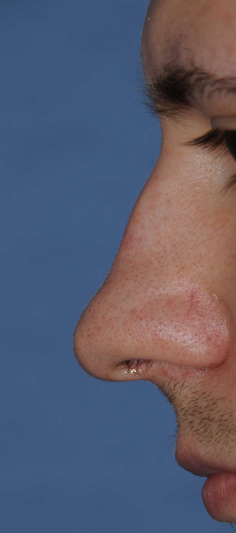 Rhinoplasty Before & After Gallery - Patient 179258 - Image 3