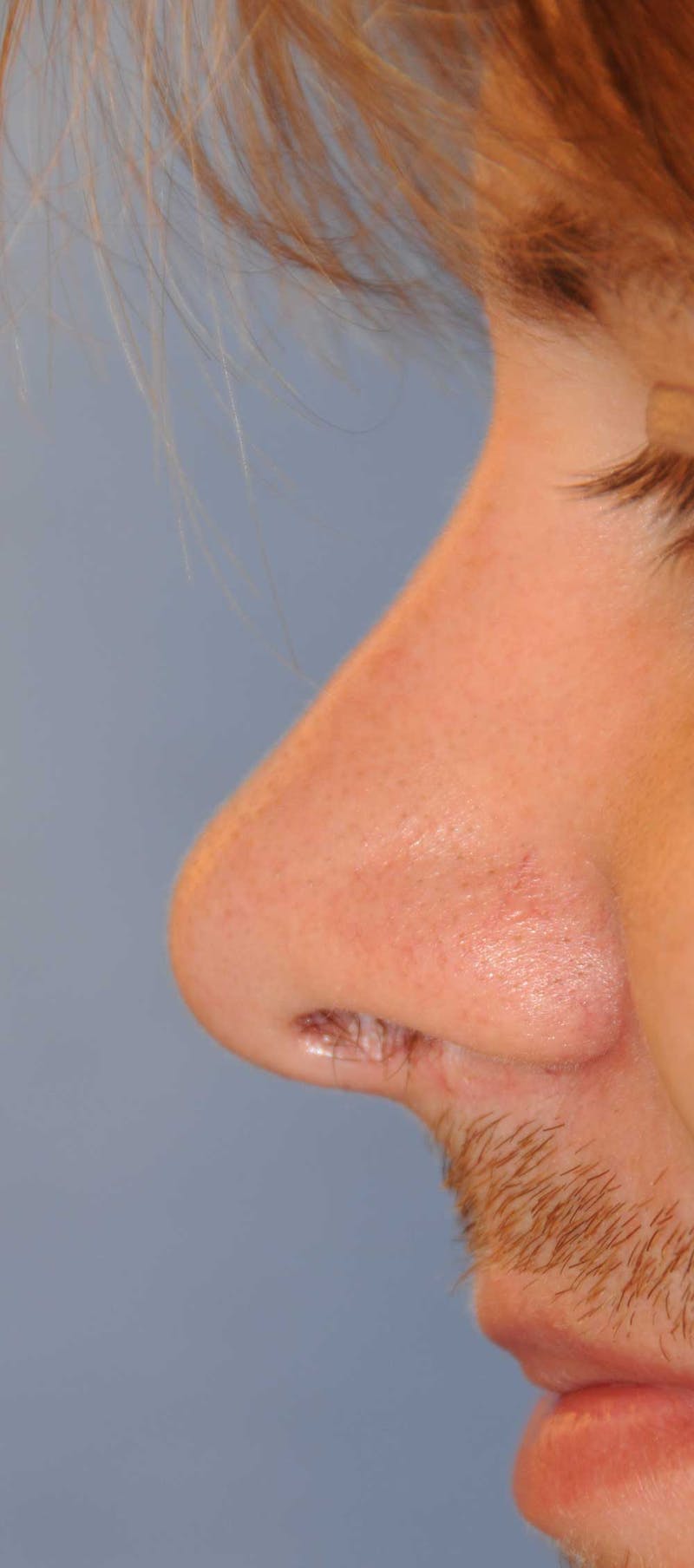 Rhinoplasty Before & After Gallery - Patient 179258 - Image 4