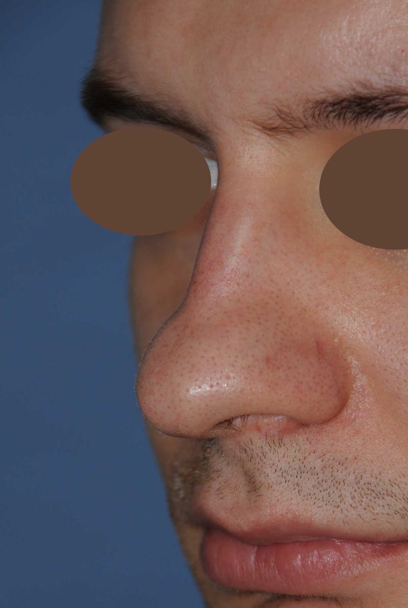 Rhinoplasty Before & After Gallery - Patient 179258 - Image 5