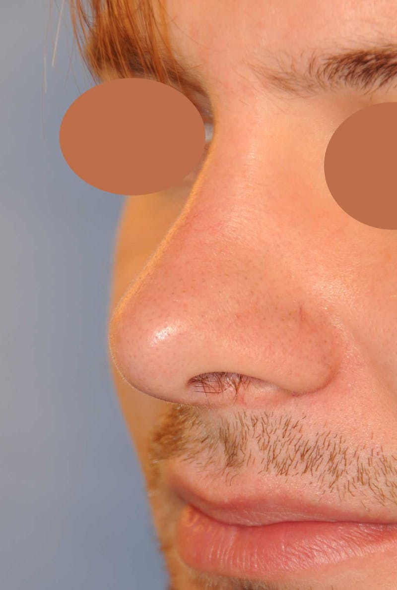 Rhinoplasty Before & After Gallery - Patient 179258 - Image 6