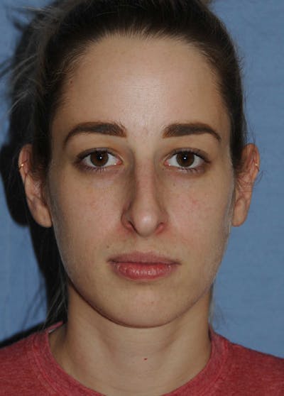 Rhinoplasty Before & After Gallery - Patient 325896 - Image 1