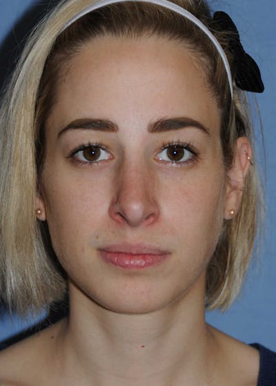 Rhinoplasty Before & After Gallery - Patient 325896 - Image 2