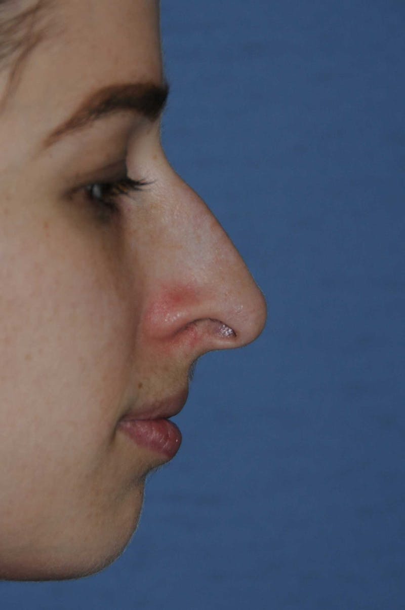 Rhinoplasty Before & After Gallery - Patient 325896 - Image 3