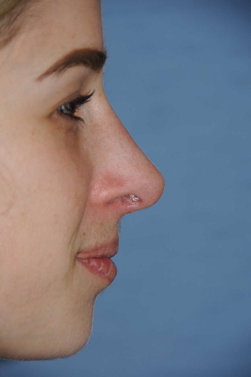 Rhinoplasty Before & After Gallery - Patient 325896 - Image 4