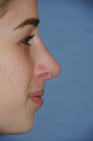Rhinoplasty Before & After Gallery - Patient 325896 - Image 4