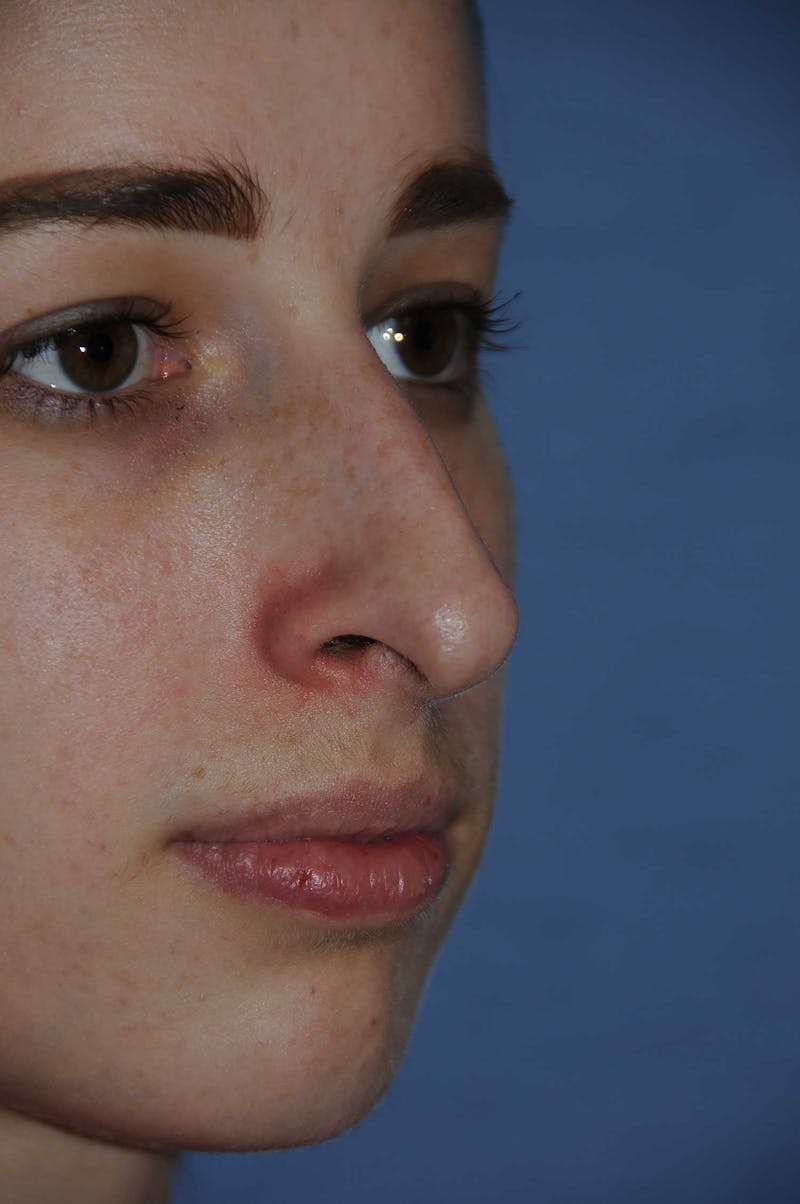 Rhinoplasty Before & After Gallery - Patient 325896 - Image 5
