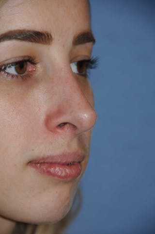 Rhinoplasty Before & After Gallery - Patient 325896 - Image 6