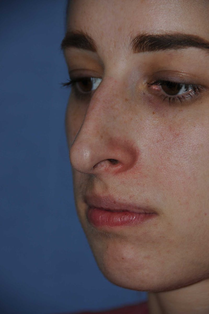 Rhinoplasty Before & After Gallery - Patient 325896 - Image 7