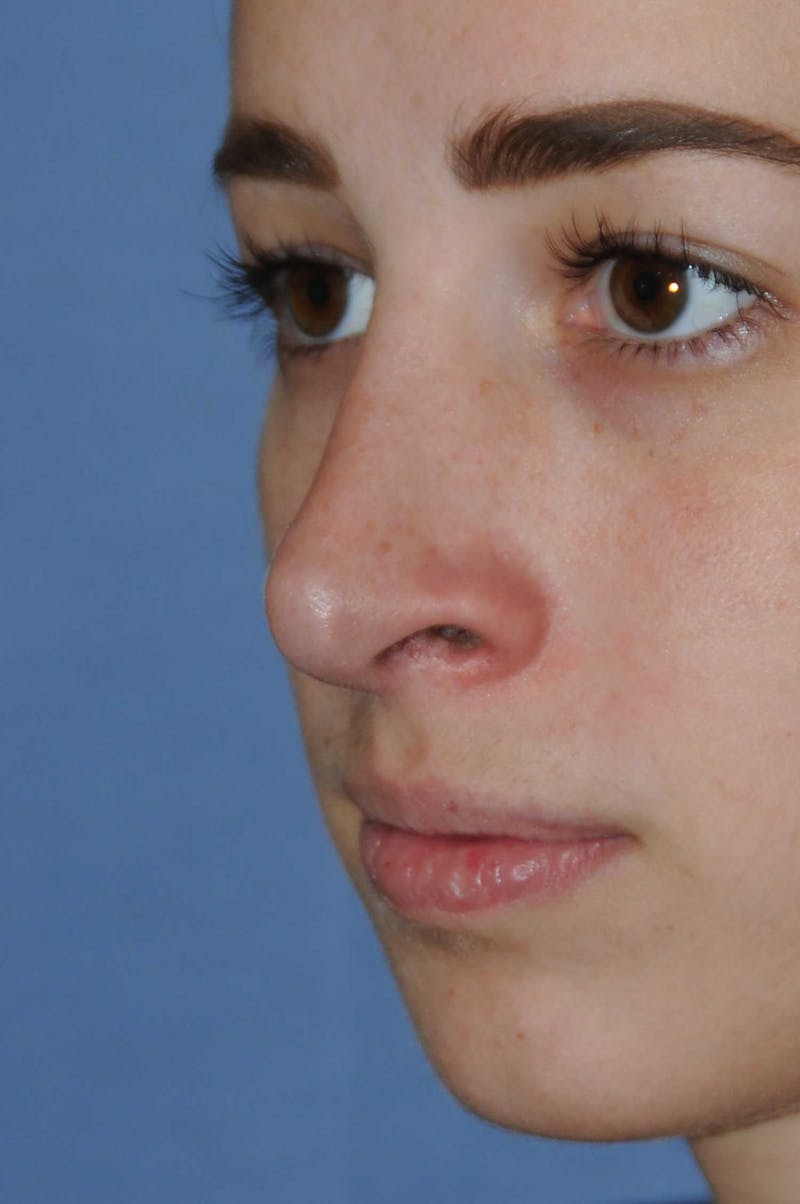 Rhinoplasty Before & After Gallery - Patient 325896 - Image 8