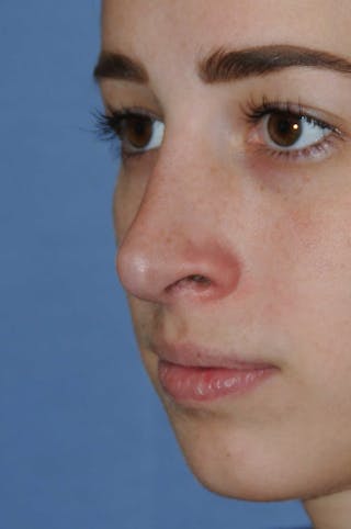 Rhinoplasty Before & After Gallery - Patient 325896 - Image 8