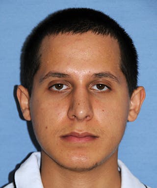 Rhinoplasty Before & After Gallery - Patient 307625 - Image 2