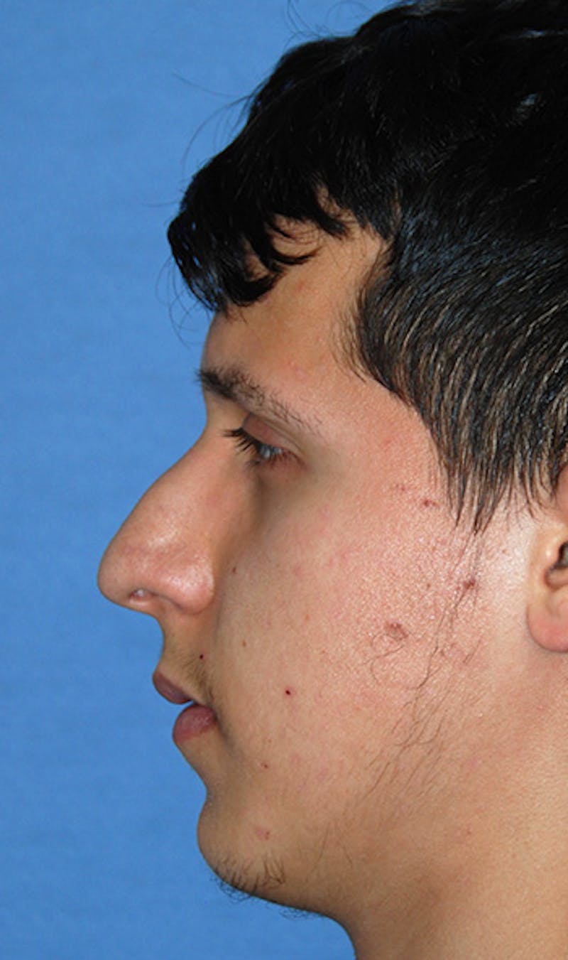 Rhinoplasty Before & After Gallery - Patient 307625 - Image 3