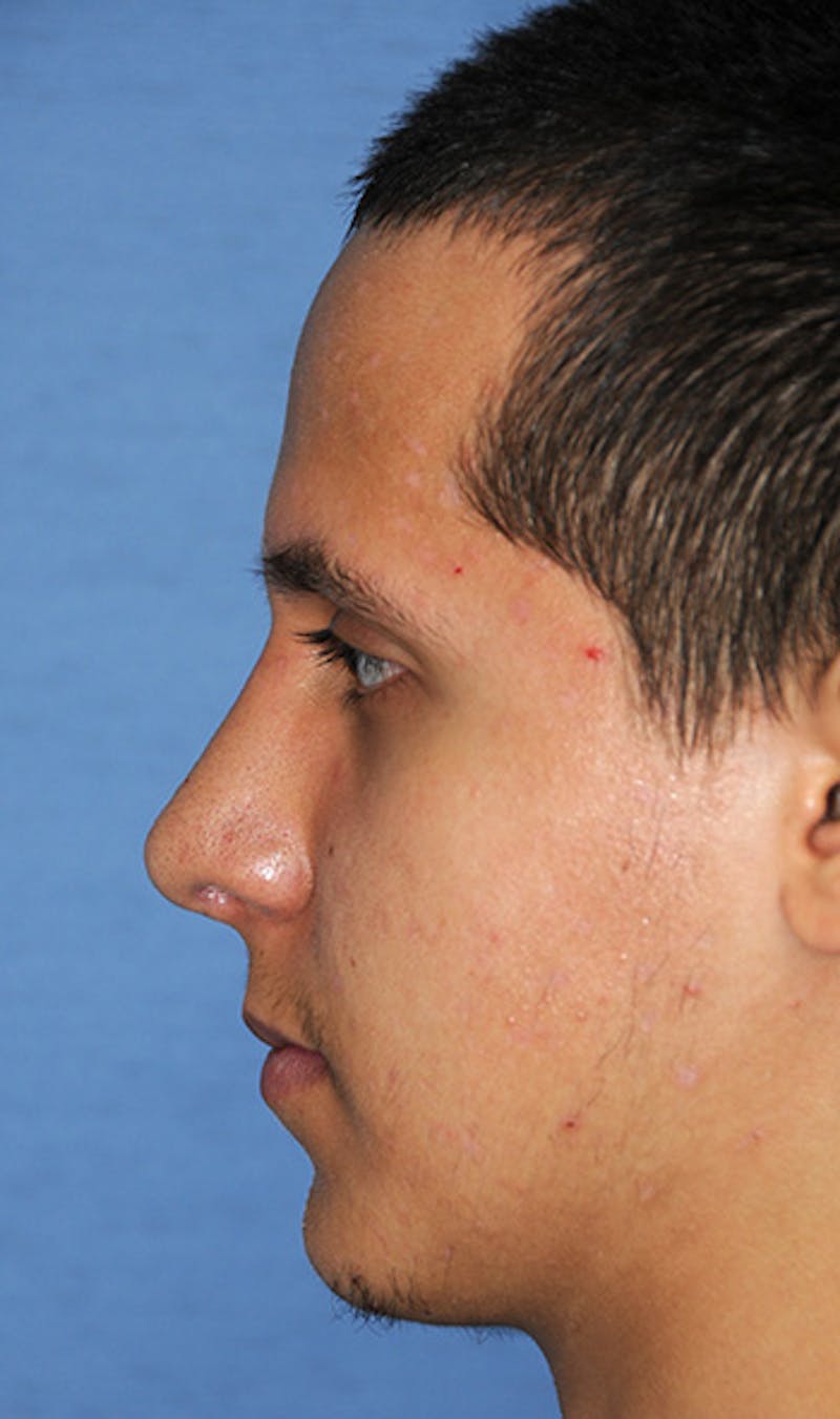 Rhinoplasty Before & After Gallery - Patient 307625 - Image 4