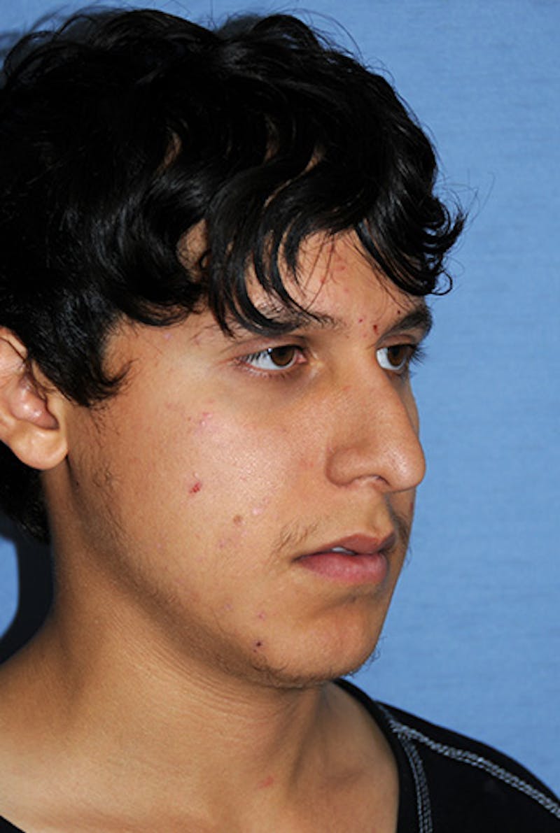 Rhinoplasty Before & After Gallery - Patient 307625 - Image 5