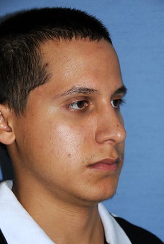 Rhinoplasty Before & After Gallery - Patient 307625 - Image 6