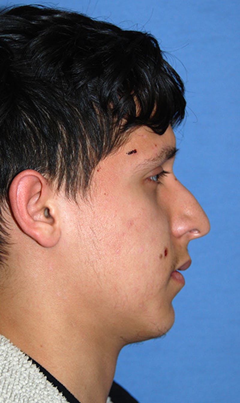 Rhinoplasty Before & After Gallery - Patient 307625 - Image 7