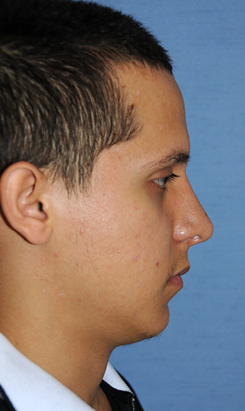 Rhinoplasty Before & After Gallery - Patient 307625 - Image 8