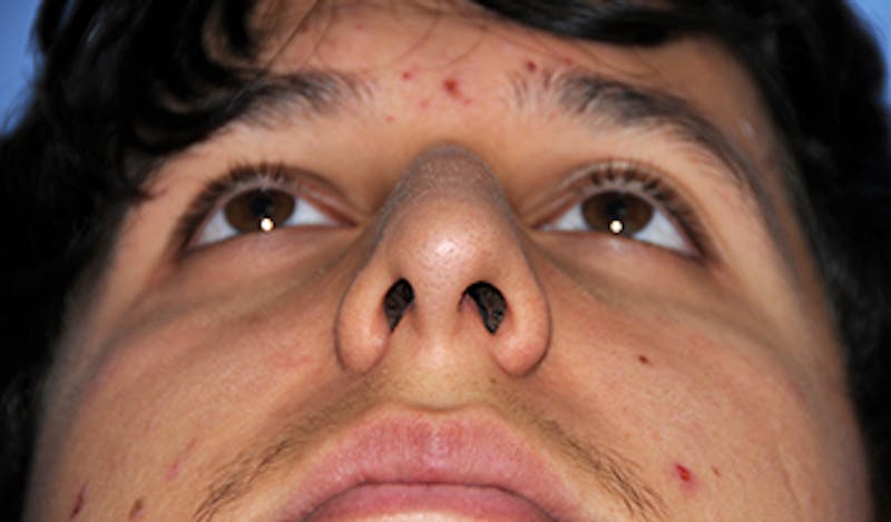 Rhinoplasty Before & After Gallery - Patient 307625 - Image 9