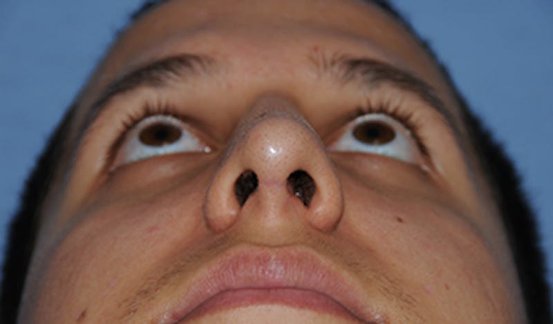 Rhinoplasty Before & After Gallery - Patient 307625 - Image 10