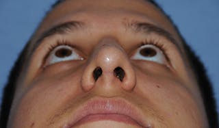 Rhinoplasty Before & After Gallery - Patient 307625 - Image 10
