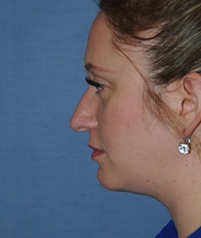 Rhinoplasty Before & After Gallery - Patient 308377 - Image 1