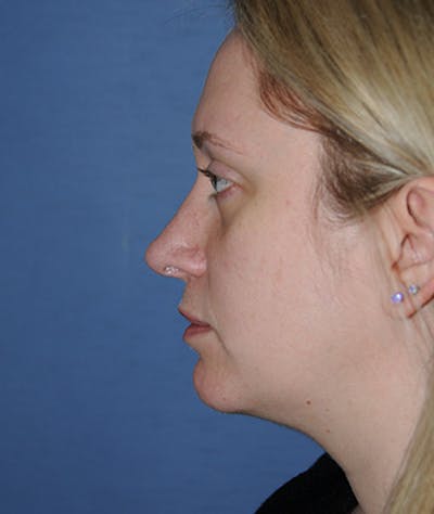 Rhinoplasty Before & After Gallery - Patient 308377 - Image 2