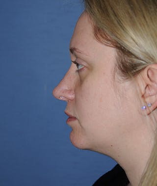 Rhinoplasty Before & After Gallery - Patient 308377 - Image 2