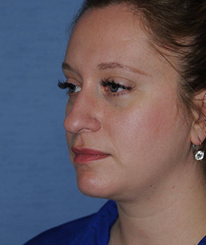 Rhinoplasty Before & After Gallery - Patient 308377 - Image 3