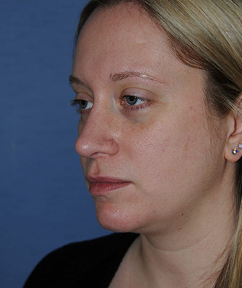 Rhinoplasty Before & After Gallery - Patient 308377 - Image 4