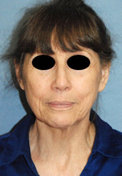 Rhinoplasty Before & After Gallery - Patient 313049 - Image 1