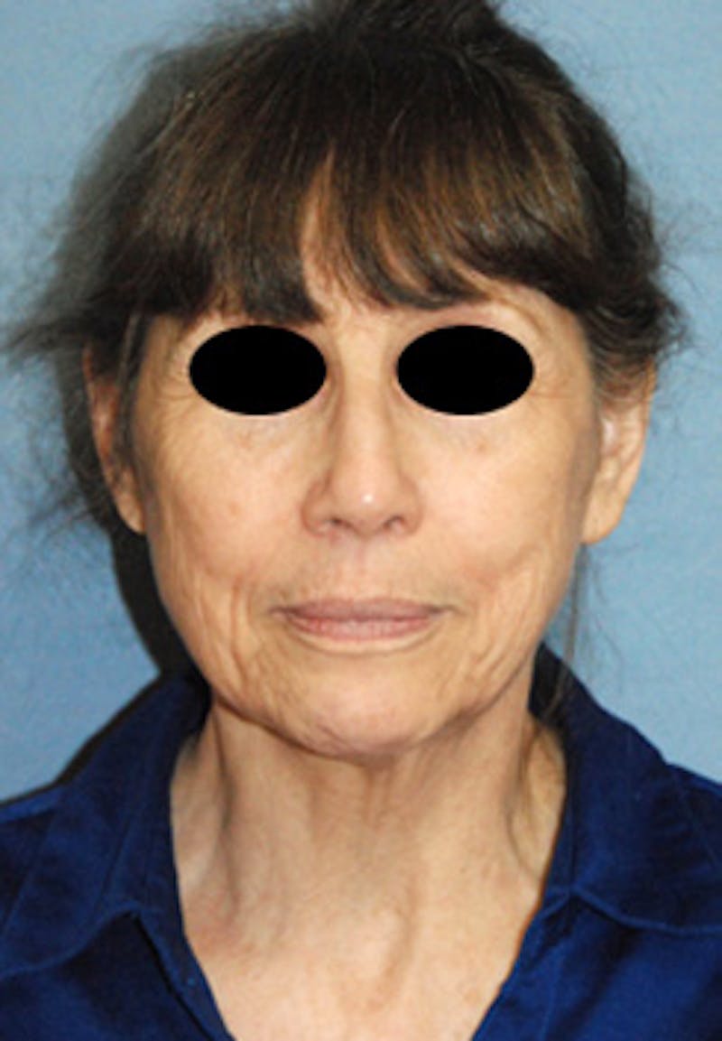 Rhinoplasty Before & After Gallery - Patient 313049 - Image 1