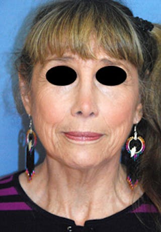Rhinoplasty Before & After Gallery - Patient 313049 - Image 2