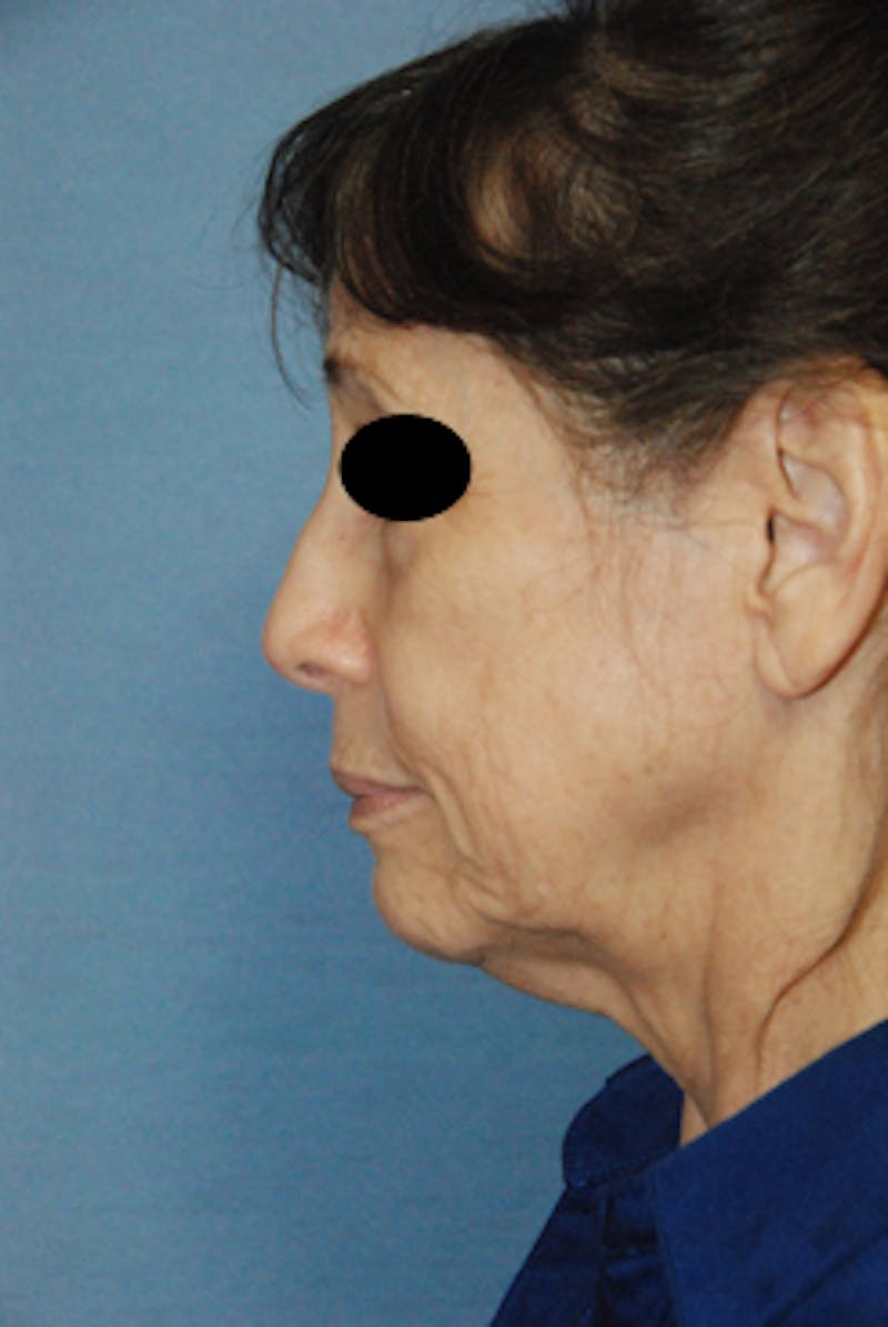 Rhinoplasty Before & After Gallery - Patient 313049 - Image 3