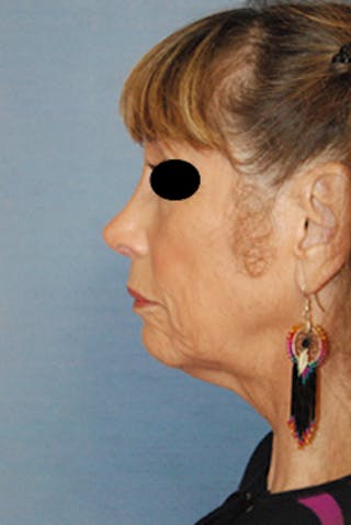 Rhinoplasty Before & After Gallery - Patient 313049 - Image 4