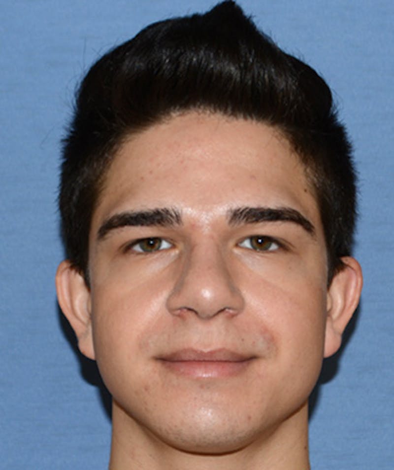Rhinoplasty Before & After Gallery - Patient 404985 - Image 2
