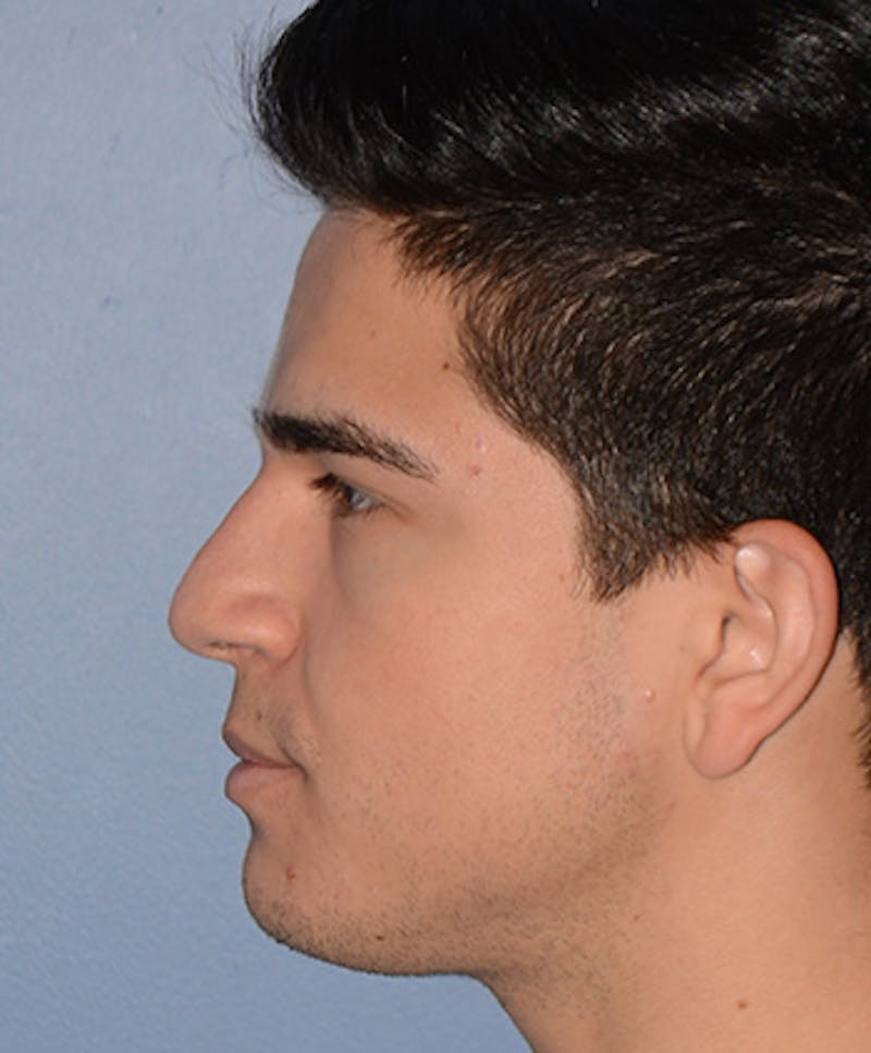 Rhinoplasty Before & After Gallery - Patient 404985 - Image 3