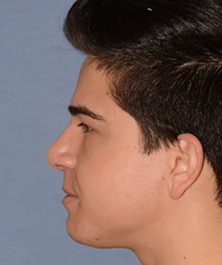 Rhinoplasty Before & After Gallery - Patient 404985 - Image 4