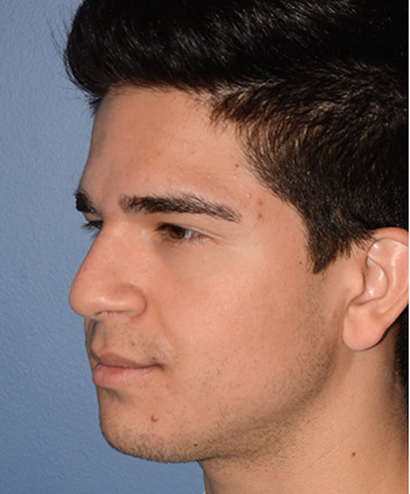 Rhinoplasty Before & After Gallery - Patient 404985 - Image 5