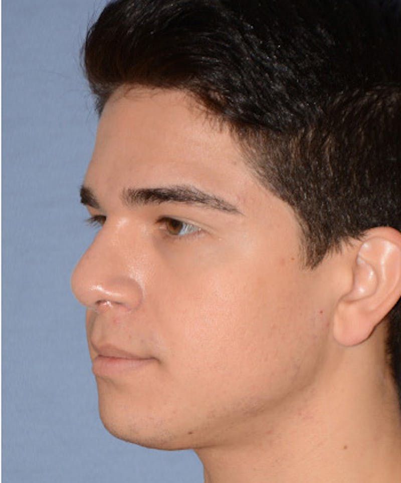 Rhinoplasty Before & After Gallery - Patient 404985 - Image 6