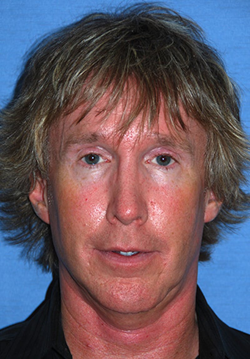 Rhinoplasty Before & After Gallery - Patient 241581 - Image 7