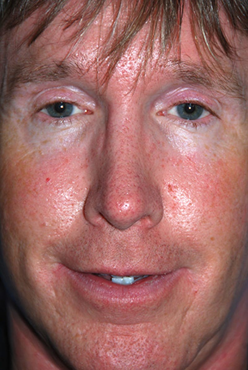 Rhinoplasty Before & After Gallery - Patient 241581 - Image 1