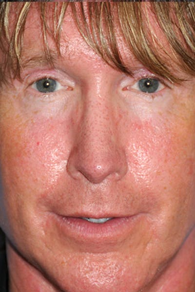 Rhinoplasty Before & After Gallery - Patient 241581 - Image 2